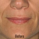 Restylane Before & After Patient #4416
