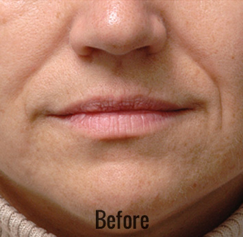 Restylane Before & After Patient #4423