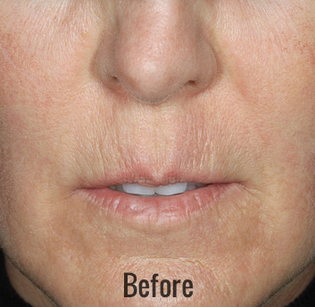 Restylane Before & After Patient #4424