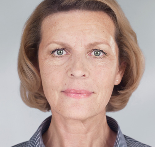 Sculptra Before & After Patient #4445