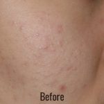 Hollywood Laser Peel (AKA Spectra) Before & After Patient #4455