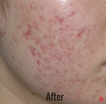 Hollywood Laser Peel (AKA Spectra) Before & After Patient #4462