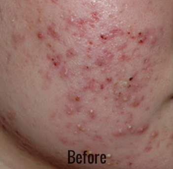 Hollywood Laser Peel (AKA Spectra) Before & After Patient #4462