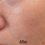 Hollywood Laser Peel (AKA Spectra) Before & After Patient #4463