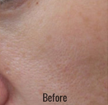 Hollywood Laser Peel (AKA Spectra) Before & After Patient #4463