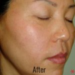 Hollywood Laser Peel (AKA Spectra) Before & After Patient #4464