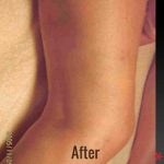 Vein Therapy Before & After Patient #4495