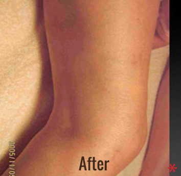 Vein Therapy Before & After Patient #4495