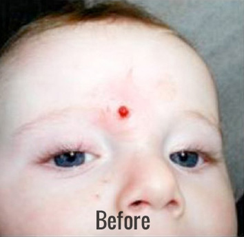 Vein Therapy Before & After Patient #4502