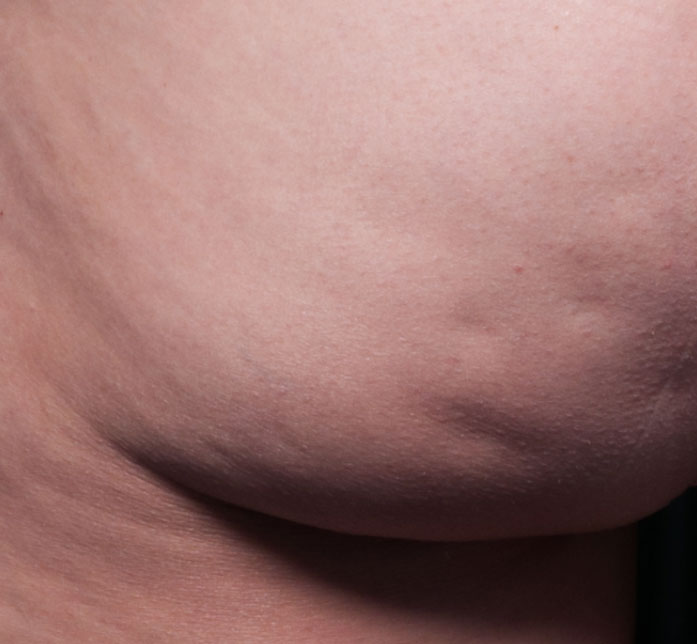 Cellfina Before & After Patient #5687