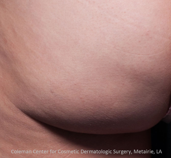 Cellfina Before & After Patient #5687