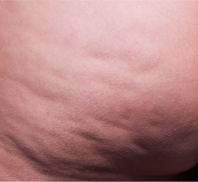 Cellfina Before & After Patient #5690
