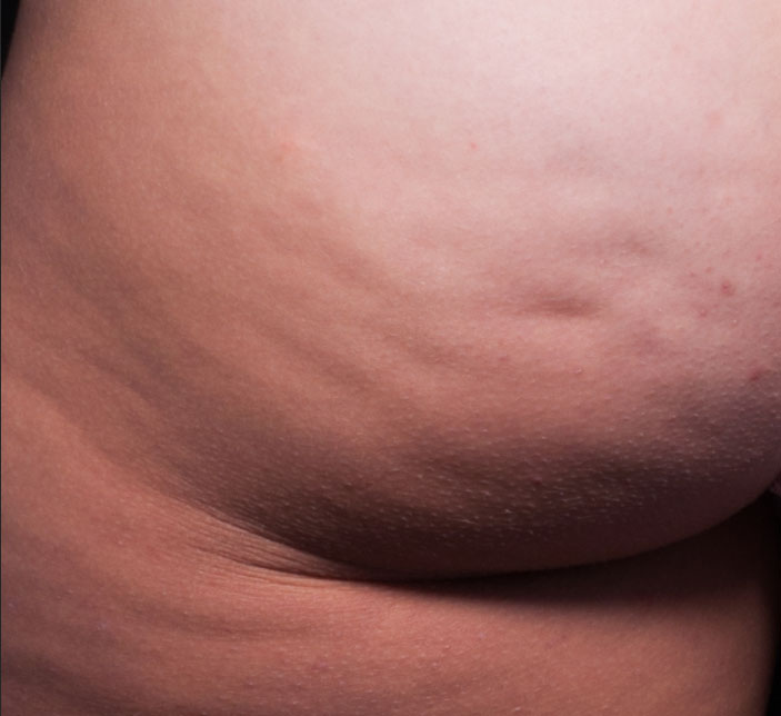 Cellfina Before & After Patient #5693