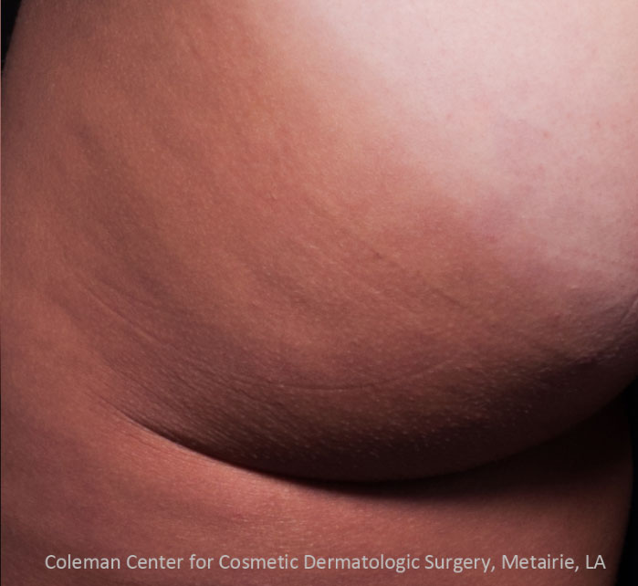 Cellfina Before & After Patient #5693