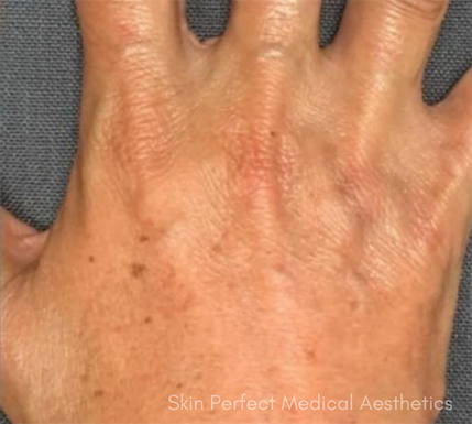 Radiesse Before & After Patient #6030