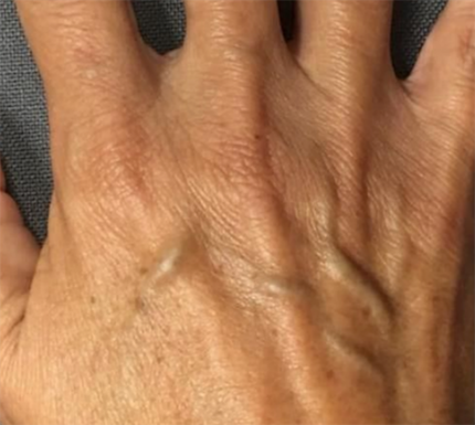 Radiesse Before & After Patient #6030
