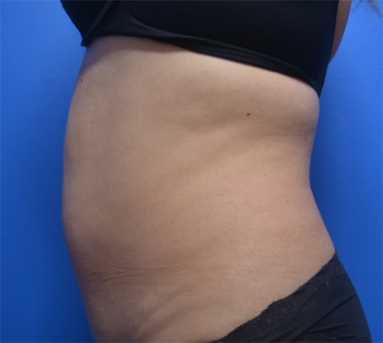 CoolSculpting Before & After Patient #6033