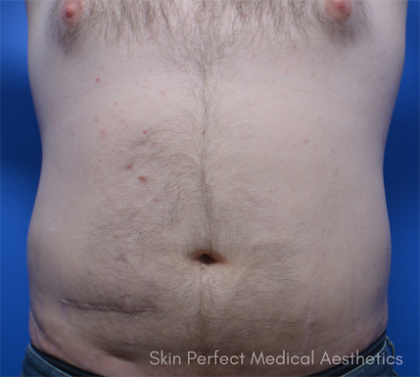 CoolSculpting Before & After Patient #6036