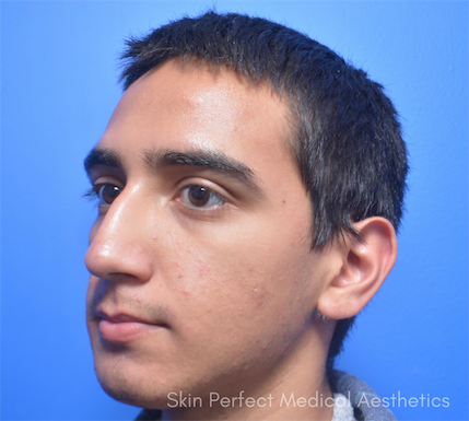 Chemical Peel Before & After Patient #6039
