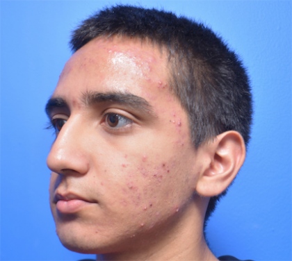 Chemical Peel Before & After Patient #6039