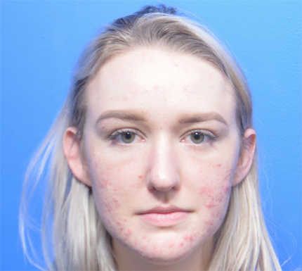 Chemical Peel Before & After Patient #6042