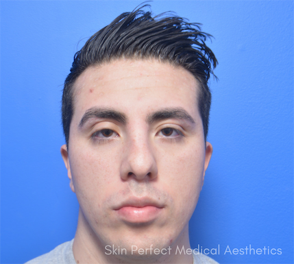 Microneedling Before & After Patient #6045
