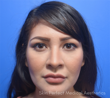 Restylane Before & After Patient #6048