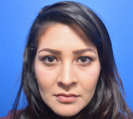 Restylane Before & After Patient #6048