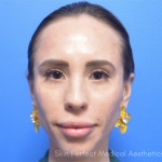 Restylane Lyft Before & After Patient #6051