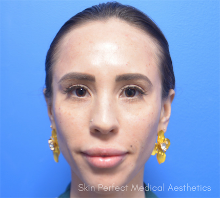 Restylane Lyft Before & After Patient #6051
