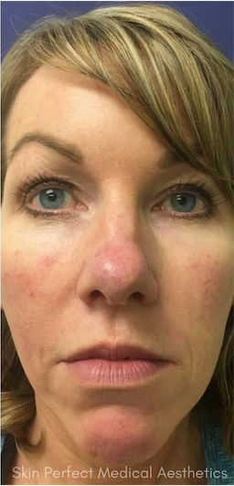 Restylane Before & After Patient #6054