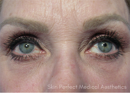 iLYFT Before & After Patient #6001