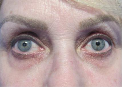 iLYFT Before & After Patient #6001