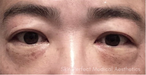 iLYFT Before & After Patient #6007