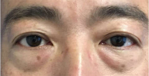 iLYFT Before & After Patient #6007