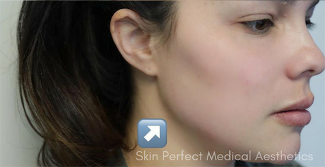 Restylane Lyft Before & After Patient #6008