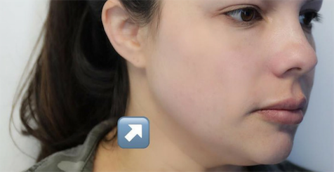 Restylane Lyft Before & After Patient #6008