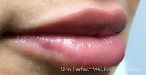 Juvederm Before & After Patient #6011