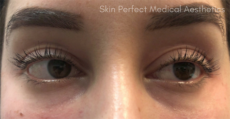 Restylane Lyft Before & After Patient #6014