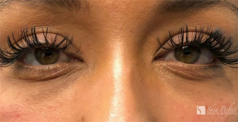Restylane Lyft Before & After Patient #6017