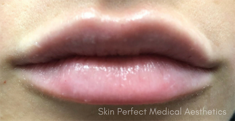Juvederm Before & After Patient #6020