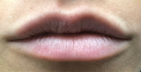Juvederm Before & After Patient #6020