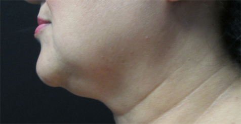 CoolSculpting Before & After Patient #6023