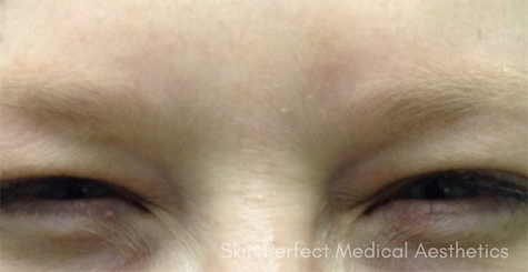 Botox, Dysport, & Xeomin Before & After Patient #6027