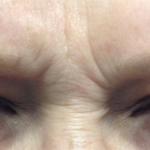 Botox, Dysport, & Xeomin Before & After Patient #6027