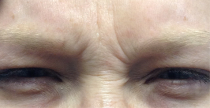 Botox, Dysport, & Xeomin Before & After Patient #6027