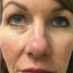 Restylane Before & After Patient #6054