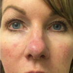 Restylane Before & After Patient #6054