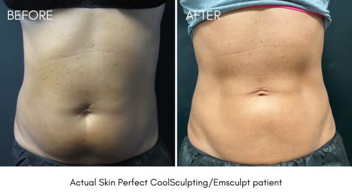 Emsculpt Rancho Cucamonga & San Bernardino