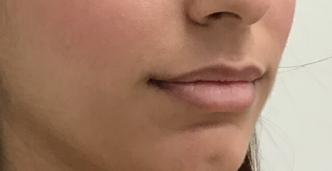 Restylane Before & After Patient #8108